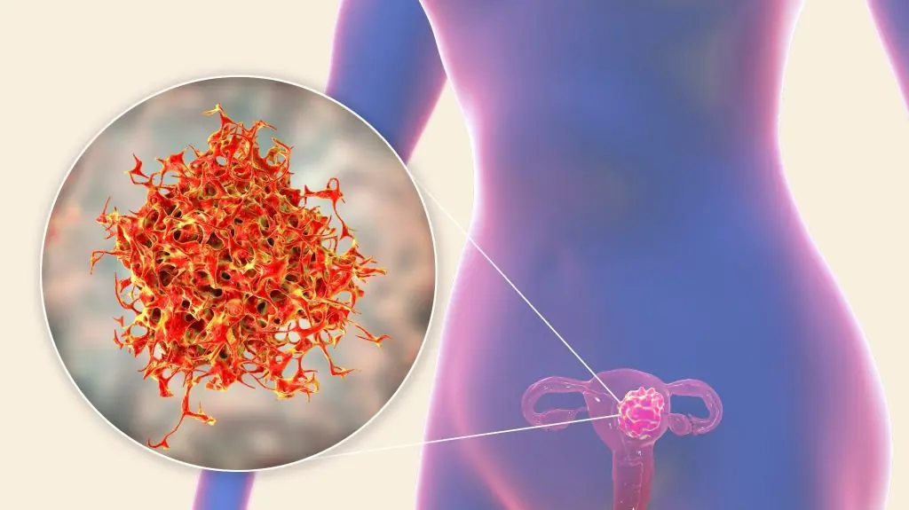 Uterine cancer
