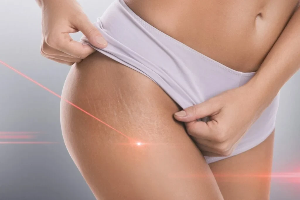 Se debarrasser rapidement naturellement vergetures esthetique 1024x683 1