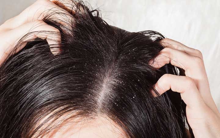 beautynfacts hair dandruff