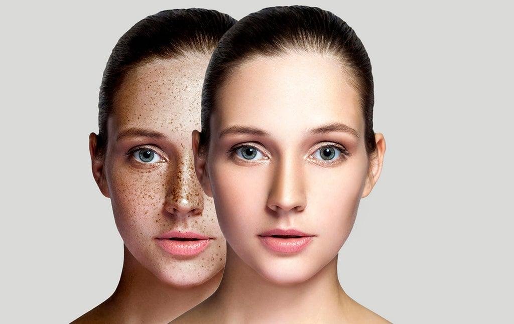 beautynfacts.com How to remove dark spots on the face 1