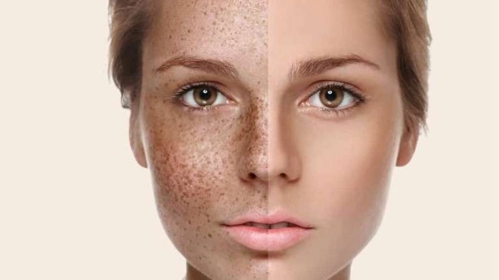 beautynfacts.com Types of sun spots on the face