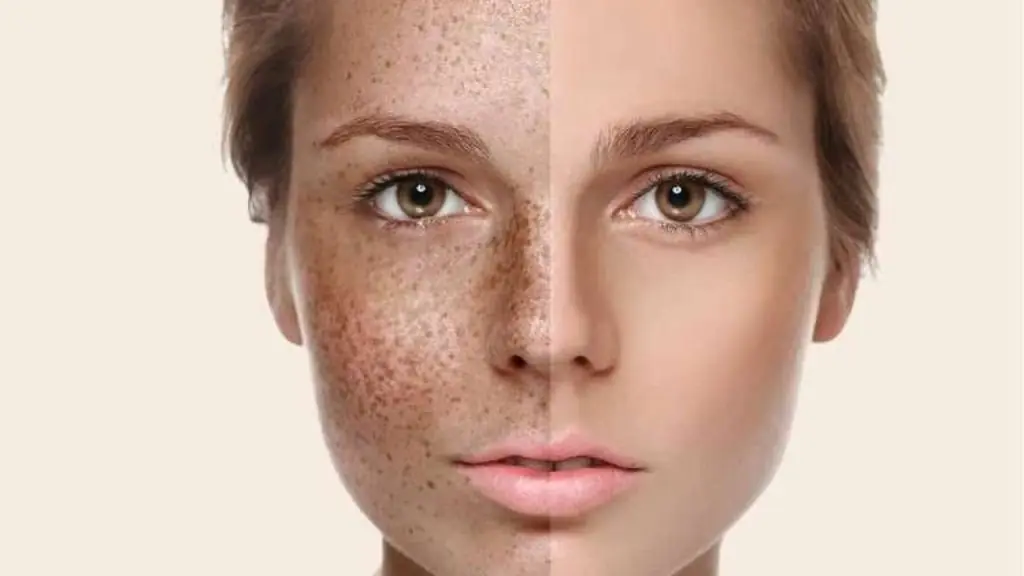 Beautynfacts. Com types of sun spots on the face