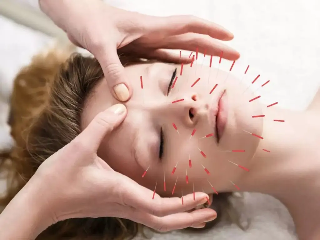 Beautynfacts. Com understanding acupuncture a brief overview