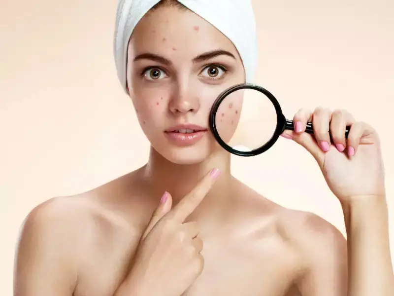 Beautynfacts. Com spots appear on the face