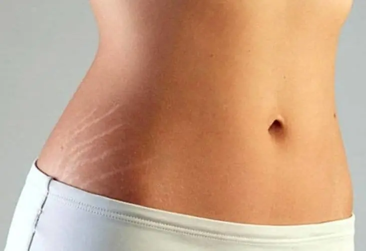 How to remove stretch marks naturally