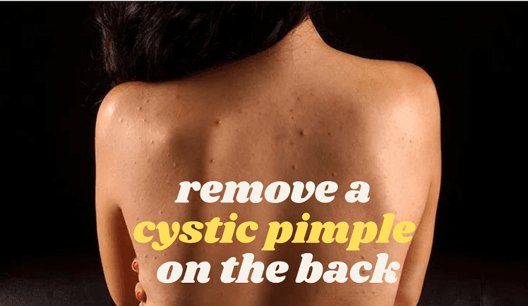 beautynfacts.com remove a cystic pimple on the back