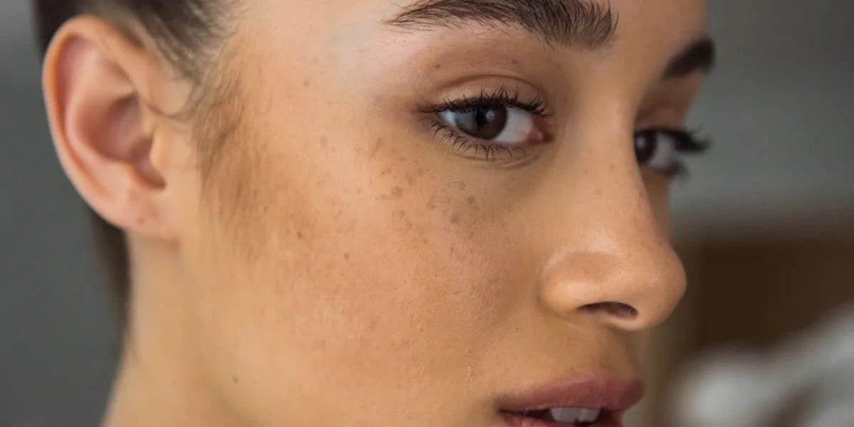 How to remove dark spots on the face