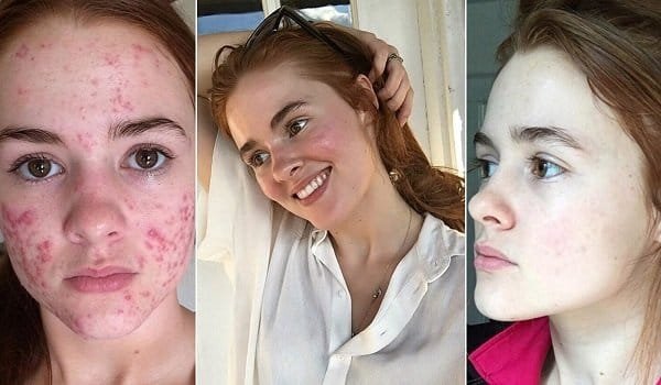 fashionnostop skin apply makeup Acne Feature