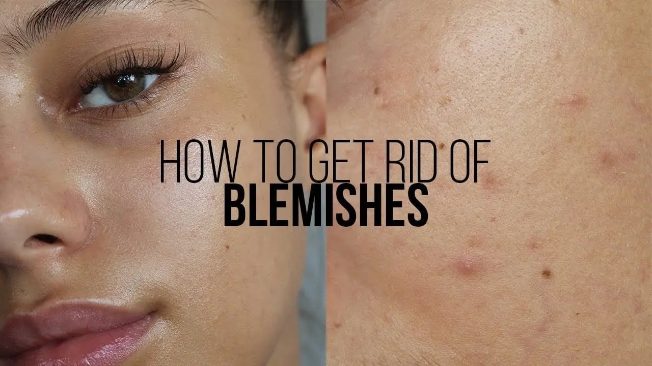 Home Remedies to Remove Blemishes From the Face Home Remedies to Remove Blemishes From the Face