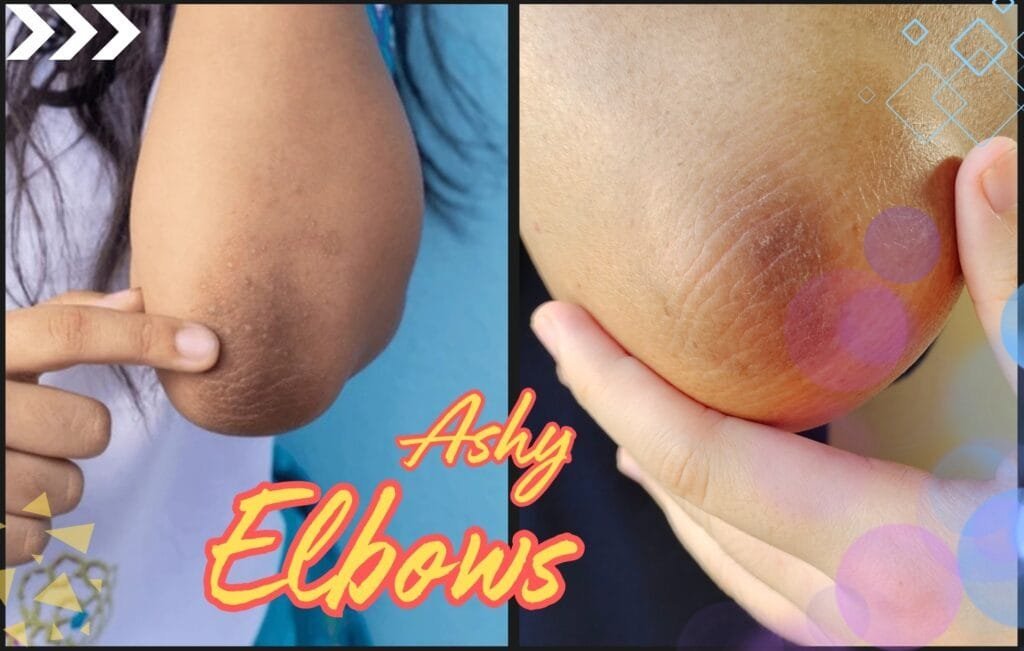 beautynfacts.com-How To Get Rid Of Ashy Elbows: Expert Tips