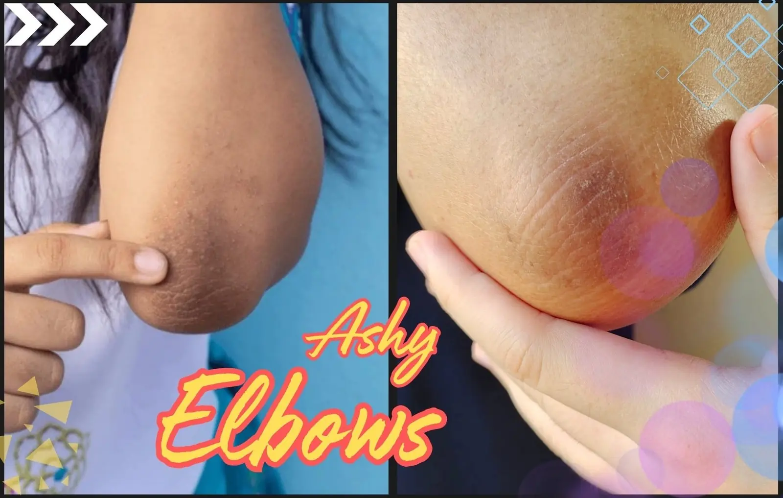 How to Get Rid of Ashy Elbows: Expert Tips