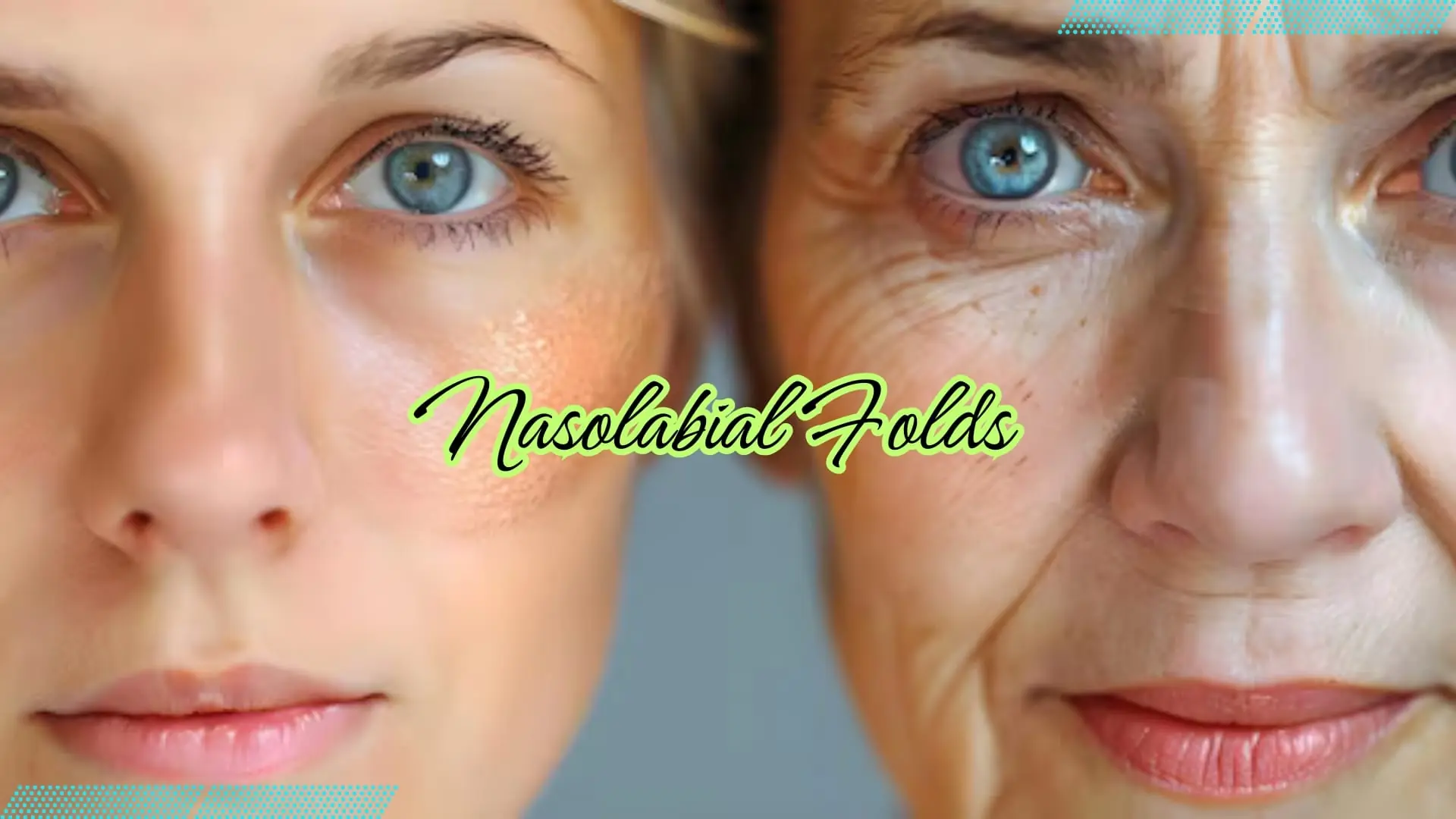 Nasolabial folds: causes, treatments, and prevention that works