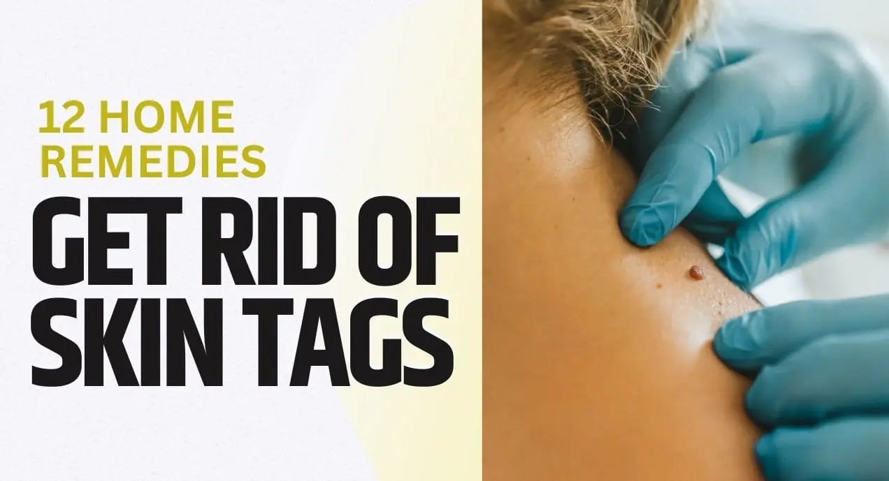 Get Rid of Skin Tags Safely: 12 Home Remedies and OTC Products