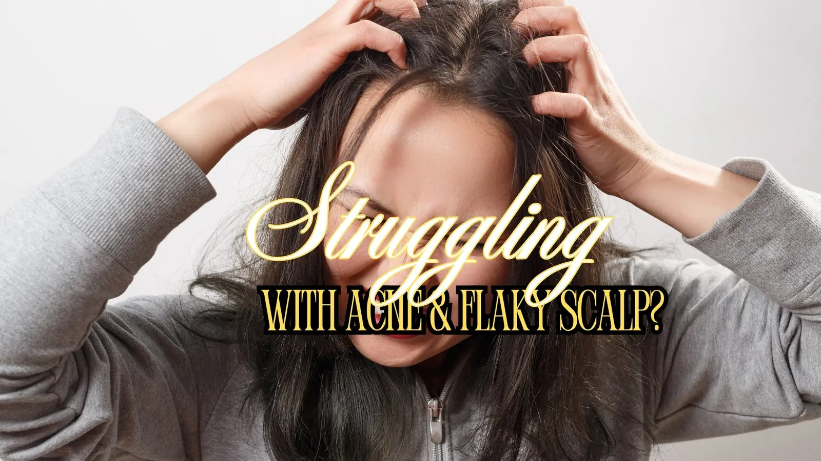 Acne and Flaky Scalp: Top Skin and Hair Triggers to Avoid